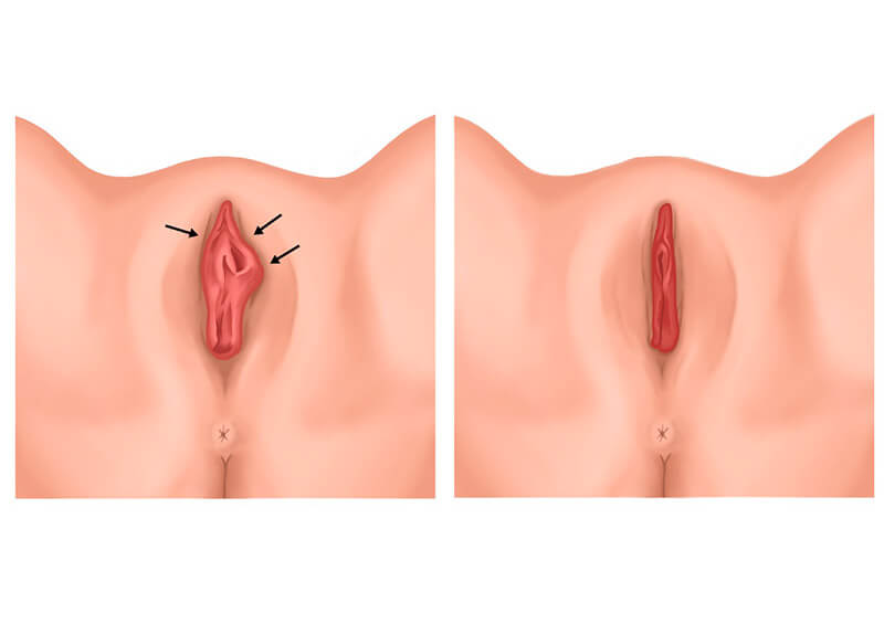 Ilustração de caso real: correção de ninfoplastia anterior (feita por cirurgião plástico), com corte apenas dos pequenos lábios mas deixando excesso de pele lateral ao clitóris.